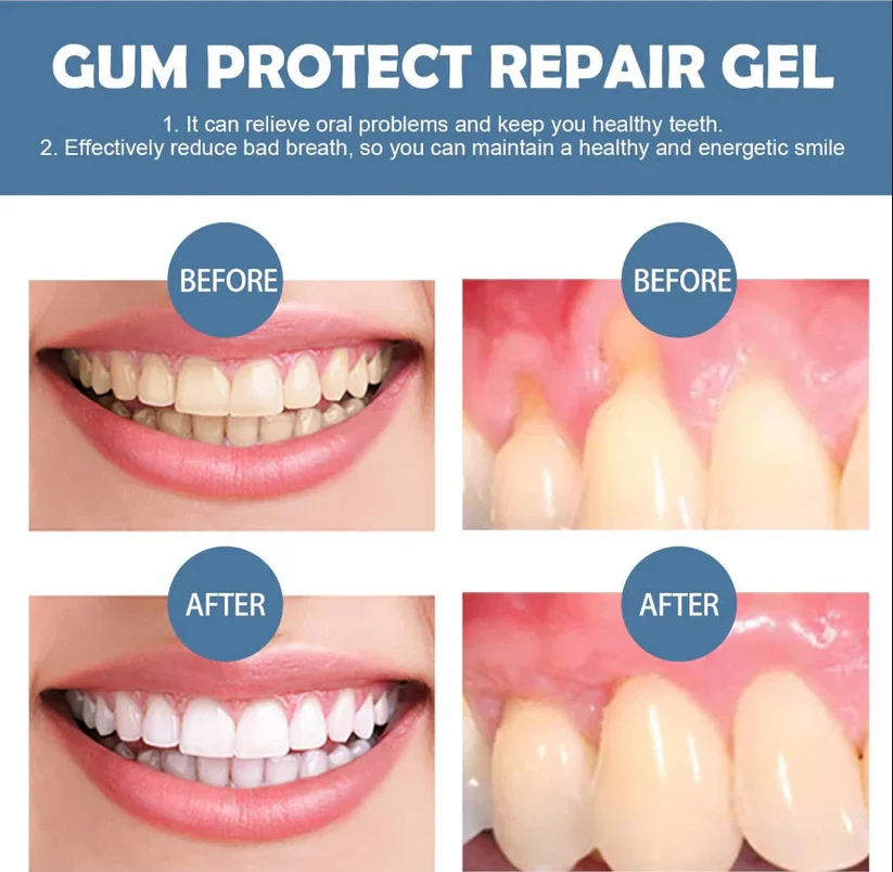 Thexer™ Teeth Repair Gel